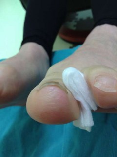 爪が剥げた後から段差が出来てしまう巻き爪 東広島市西条で巻き爪矯正なら 東広島巻き爪矯正センター